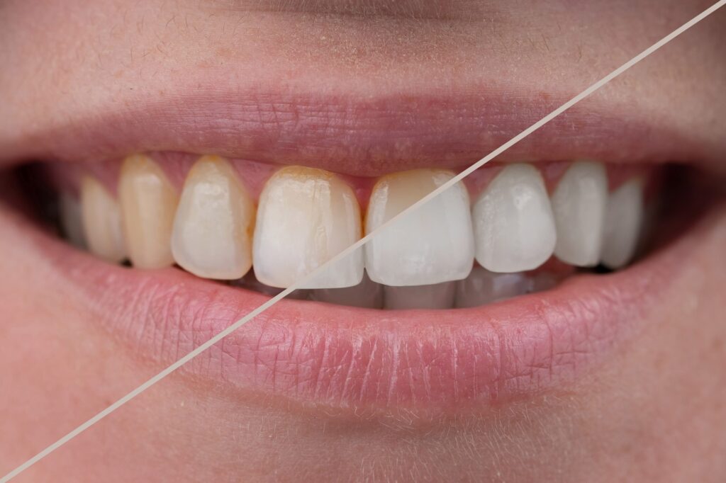  A Guide to Teeth Bleaching: What You Need to Know